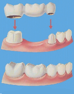 What is a bridge? – Looking for a San Diego Dentist? Pacific Beach