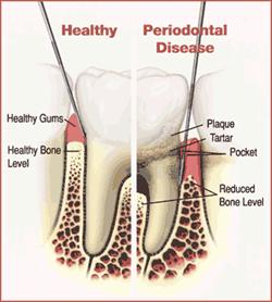 Gum Disease Prevention and Treatment – Looking for a San Diego Dentist