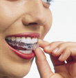 invisalign procedure san diego