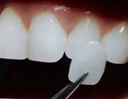 porcelain veneers san diego