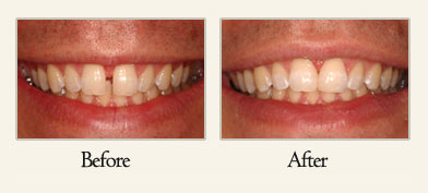 Porcelain veneers san diego